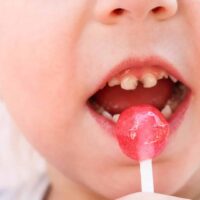 Child,Eats,Candy.,Girl,Has,Caries,On,Teeth.